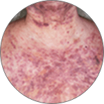 Purple skin lesions caused by BPDCN